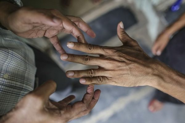 leprosy stigma still rampant in many countries experts raise alarm over judgemental attitudes